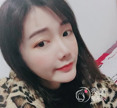 上海华美李志海颧弓降低案例。