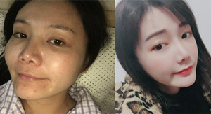 上海华美李志海颧弓降低案例。