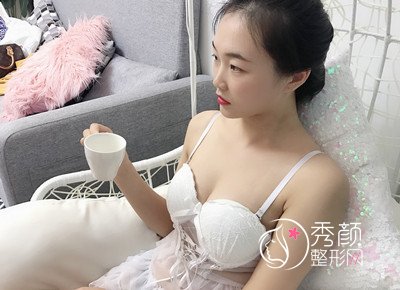 上海华美李健院长做的傲诺拉绚耀260cc的假体隆胸,圆满了。