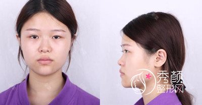 上海华美张朋鼻部手术+眼部手术案例。