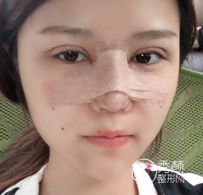 上海华美张朋鼻部手术+眼部手术案例。