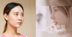 <b>上海华美张朋做鼻子怎么样,价格 案例</b>