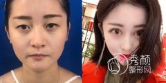 <b>上海华美董亮做双眼皮怎么样,价格 案例</b>