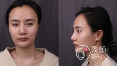 李志海削骨案例