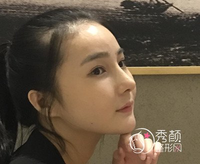 我在上海华美李志海那儿做的下颌角整形，花了我33000大洋。