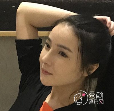 我在上海华美李志海那儿做的下颌角整形，花了我33000大洋。