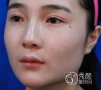 我在上海华美李志海那儿做的下颌角整形，花了我33000大洋。