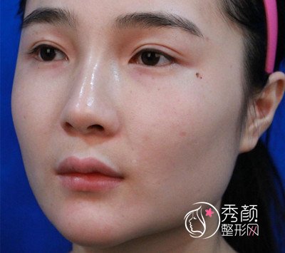 我在上海华美李志海那儿做的下颌角整形,花了我33000大洋。