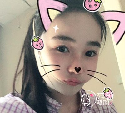 我在上海华美李志海那儿做的下颌角整形,花了我33000大洋。