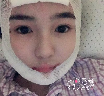 我在上海华美李志海那儿做的下颌角整形,花了我33000大洋。