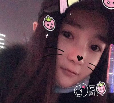 我在上海华美李志海那儿做的下颌角整形,花了我33000大洋。