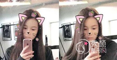 我在上海华美李志海那儿做的下颌角整形,花了我33000大洋。
