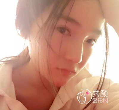 我在上海华美李志海那儿做的下颌角整形，花了我33000大洋。