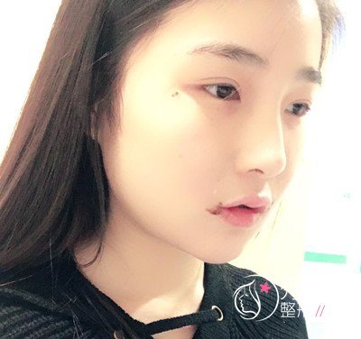 我在上海华美李志海那儿做的下颌角整形,花了我33000大洋。