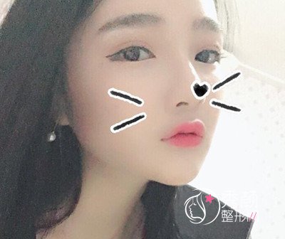 我在上海华美李志海那儿做的下颌角整形,花了我33000大洋。