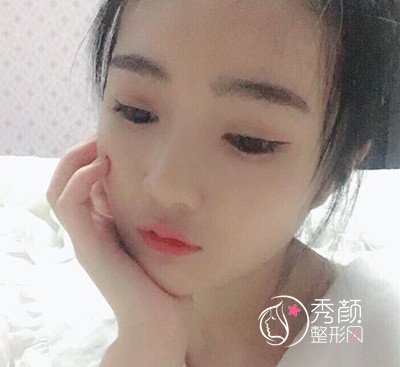 我在上海华美李志海那儿做的下颌角整形，花了我33000大洋。