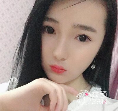 我在上海华美李志海那儿做的下颌角整形,花了我33000大洋。