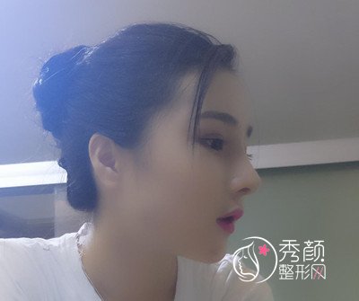 我在上海华美李志海那儿做的下颌角整形,花了我33000大洋。