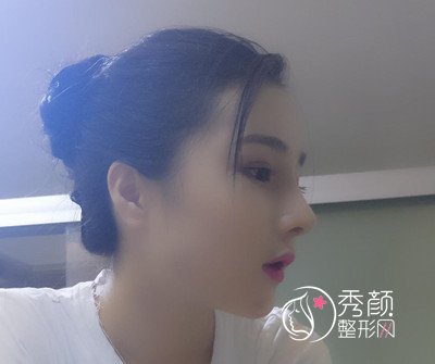 我在上海华美李志海那儿做的下颌角整形，花了我33000大洋。