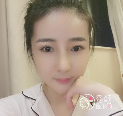 我在上海华美李志海那儿做的下颌角整形，花了我33000大洋。