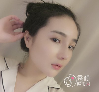 我在上海华美李志海那儿做的下颌角整形，花了我33000大洋。