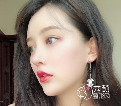 分享鼻王龚湛医生给我做鼻部手术隆鼻.