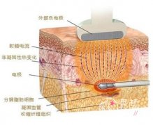 黄金微雕多少钱?可以维持多久呢?有后遗症吗?