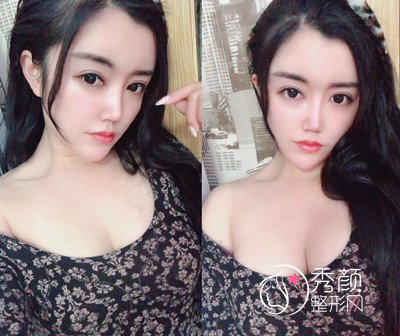 从南昌到上海首尔丽格做隆胸手术,大胸梦。