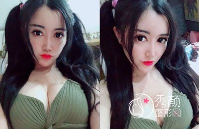 从南昌到上海首尔丽格做隆胸手术,大胸梦。