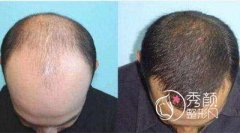 上海九院植发怎么样,靠谱吗,怎么收费的?