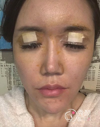 广州韩妃割双眼皮好吗,韩妃割双眼皮案例。