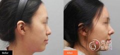 <b>巫文云、王军、牛勇敢哪个隆鼻好,技术分析。</b>