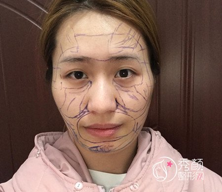 找乔爱军80000做的全脸脂肪填充,原来贵也有贵的道理啊。