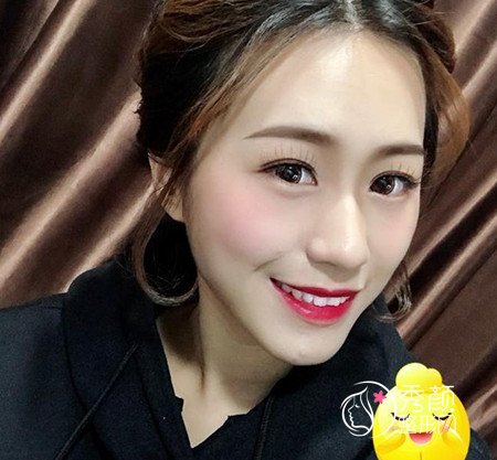 找乔爱军80000做的全脸脂肪填充,原来贵也有贵的道理啊。