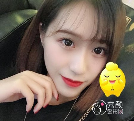 找乔爱军80000做的全脸脂肪填充,原来贵也有贵的道理啊。