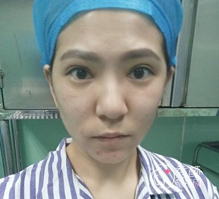 拒绝颧骨内推,上海首尔丽格金柱医生做了全脸填充。