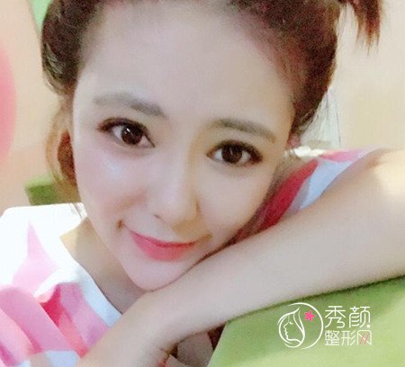 拒绝颧骨内推,上海首尔丽格金柱医生做了全脸填充。