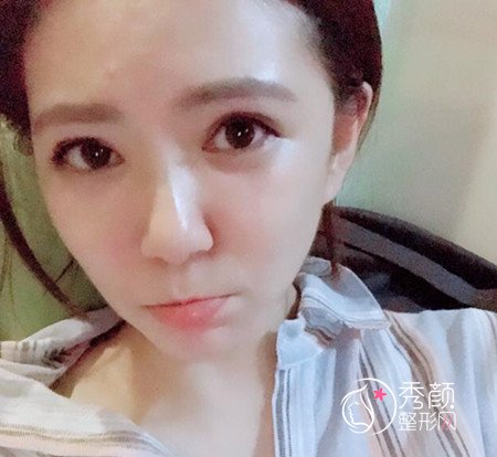 拒绝颧骨内推,上海首尔丽格金柱医生做了全脸填充。