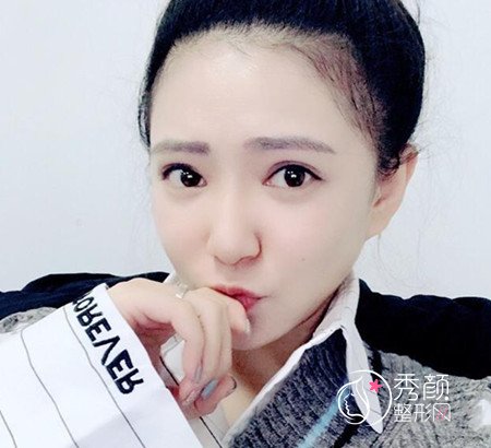 拒绝颧骨内推,上海首尔丽格金柱医生做了全脸填充。