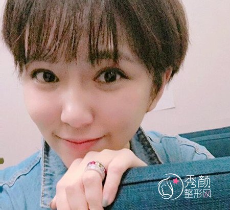 拒绝颧骨内推,上海首尔丽格金柱医生做了全脸填充。
