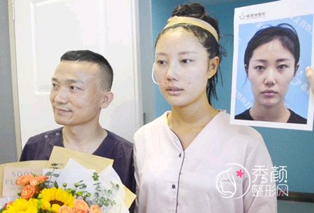武汉杨权明给我做的鼻子惊艳了我,价格贵也不是问题。