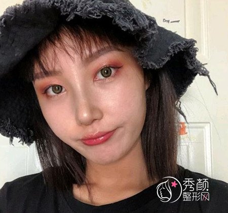 武汉杨权明给我做的鼻子惊艳了我,价格贵也不是问题。