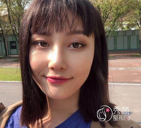 武汉杨权明给我做的鼻子惊艳了我,价格贵也不是问题。