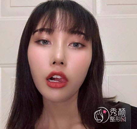 武汉杨权明给我做的鼻子惊艳了我,价格贵也不是问题。