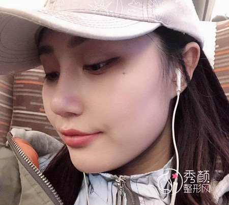 武汉杨权明给我做的鼻子惊艳了我,价格贵也不是问题。