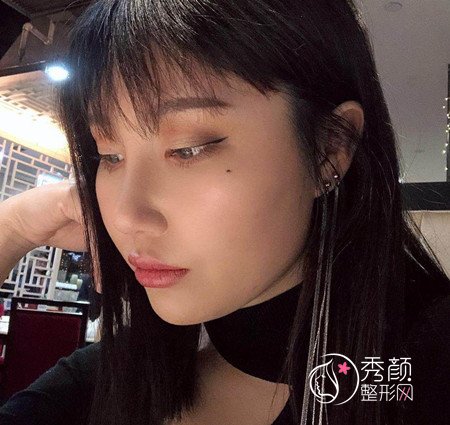 武汉杨权明给我做的鼻子惊艳了我,价格贵也不是问题。