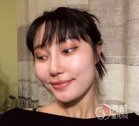 武汉杨权明给我做的鼻子惊艳了我,价格贵也不是问题。