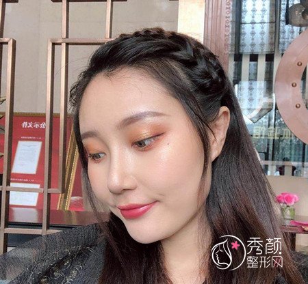 武汉杨权明给我做的鼻子惊艳了我,价格贵也不是问题。