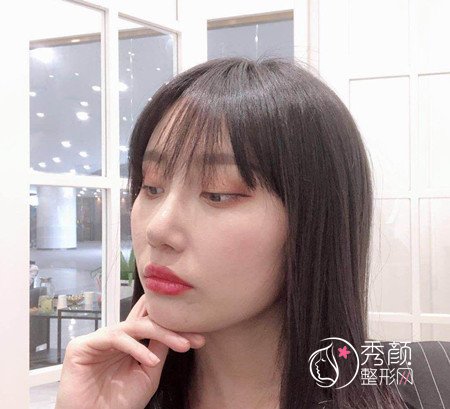 武汉杨权明给我做的鼻子惊艳了我,价格贵也不是问题。