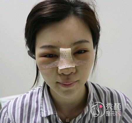 武汉刘波50000人民币做的肋骨鼻子，恢复好了各种开心。